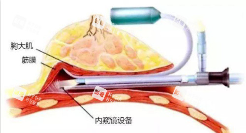 内窥镜隆胸示意图.jpg