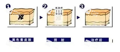 激光祛雀斑的过程.png 激光祛雀斑的过程.png