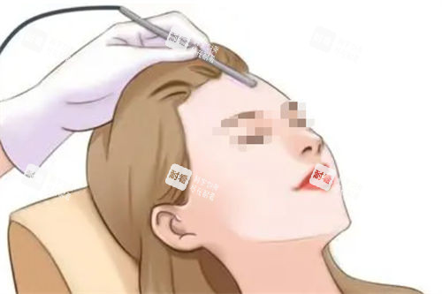 激光过程展示图.jpg 激光过程展示图.jpg