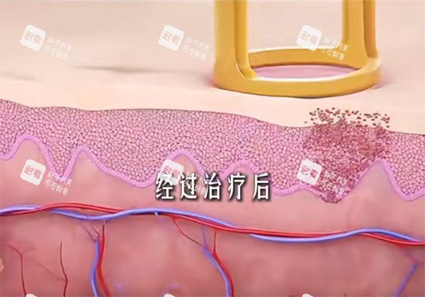 调Q激光原理细节图.jpg 调Q激光原理细节图.jpg