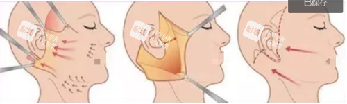手术除皱示意图.png 手术除皱示意图.png