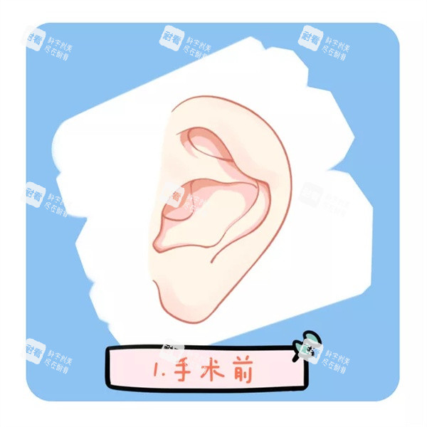 耳畸形矫正.jpg 耳畸形矫正.jpg