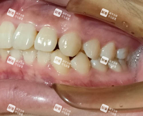 需要矫正的牙齿照片.jpg 需要矫正的牙齿照片.jpg