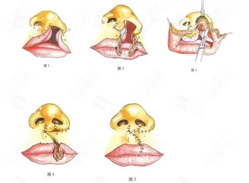 唇腭裂修复过程简易卡通示意图.jpg 唇腭裂修复过程简易卡通示意图.jpg