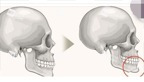 下巴截骨骨骼剖面图.png 下巴截骨骨骼剖面图.png