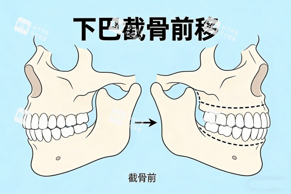 下巴截骨前移卡通图.jpg 下巴截骨前移卡通图.jpg