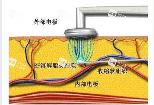 黄金微雕原理.png 黄金微雕原理.png