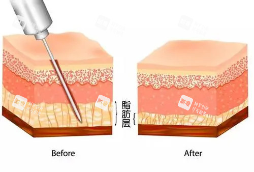 吸脂前后对比卡通示意图.jpg