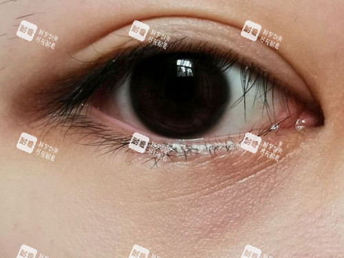 眼下细纹实拍.jpg 眼下细纹实拍.jpg