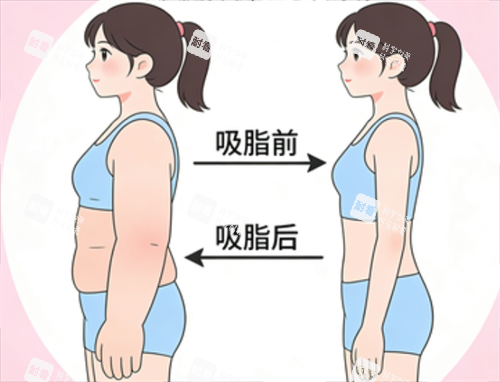 手臂吸脂成效.png 手臂吸脂成效.png