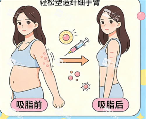 手臂吸脂前后的对比.png 手臂吸脂前后的对比.png