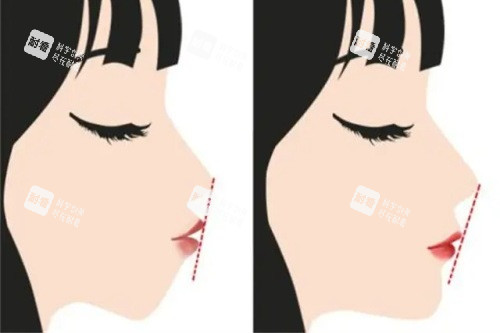 正颌手术前后的对比图.JPG 正颌手术前后的对比图.JPG
