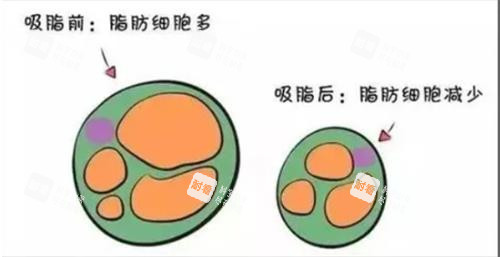 吸脂手术前后脂肪变化.png 吸脂手术前后脂肪变化.png
