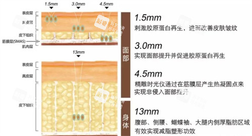 意大利时光术可深入的皮肤层次.jpg 意大利时光术可深入的皮肤层次.jpg