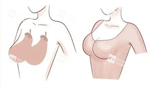 胸部下垂.jpg
