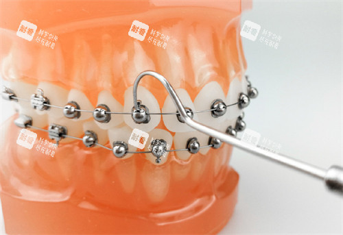 牙齿矫正OBrace球面托槽矫正牙套模型.jpg 牙齿矫正OBrace球面托槽矫正牙套模型.jpg
