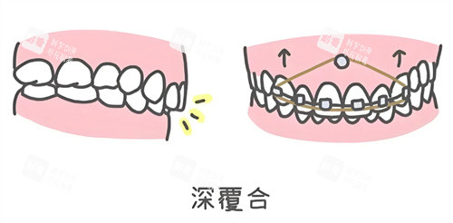 深覆合矫正.jpg 深覆合矫正.jpg