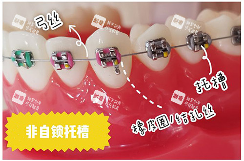 牙齿矫正非自锁托槽.jpg