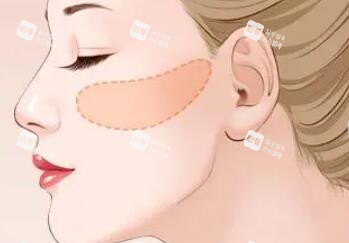 颧骨整形手术.jpg