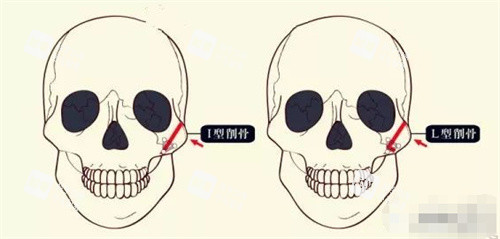 颧骨整形图片.jpg