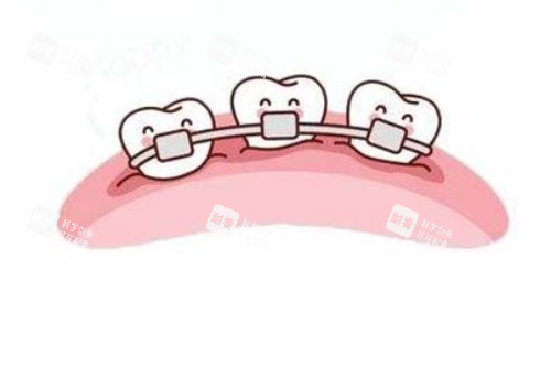 畸形牙齿矫正卡通图.jpg
