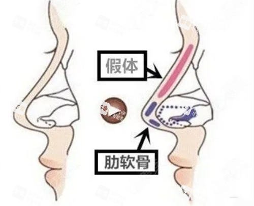 隆鼻示意图.JPG 隆鼻示意图.JPG