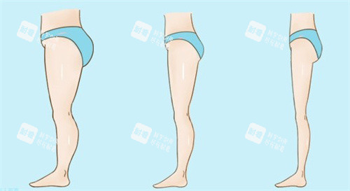腿部吸脂瘦身前后.jpg 腿部吸脂瘦身前后.jpg