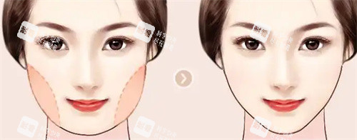 面部吸脂.jpg