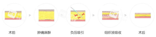 吸脂过程图解.jpg 吸脂过程图解.jpg