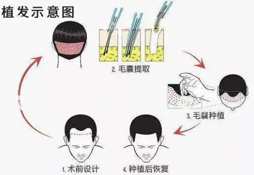 植发示意图.JPG 植发示意图.JPG