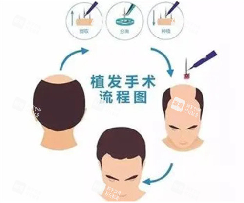 植发手术步骤图.jpg
