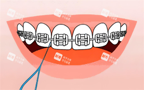 金属牙齿矫正卡通图片.jpg 金属牙齿矫正卡通图片.jpg