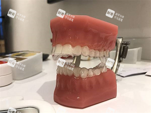 隐形牙齿矫正牙套模型.jpg 隐形牙齿矫正牙套模型.jpg