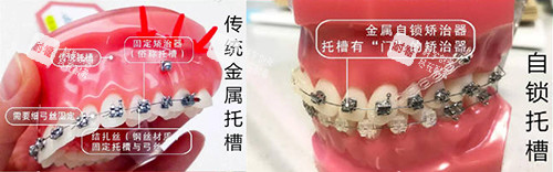 牙齿矫正牙套对比实物展示图.jpg 牙齿矫正牙套对比实物展示图.jpg