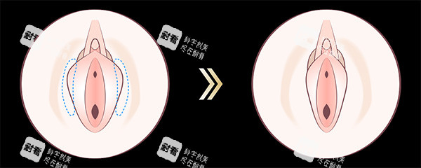 阴唇一长一短改善图片.jpg