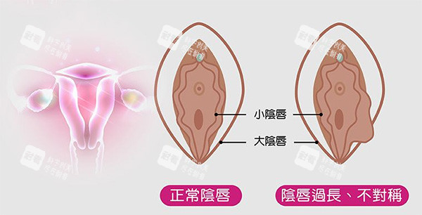 阴唇不对称改善照片.jpg