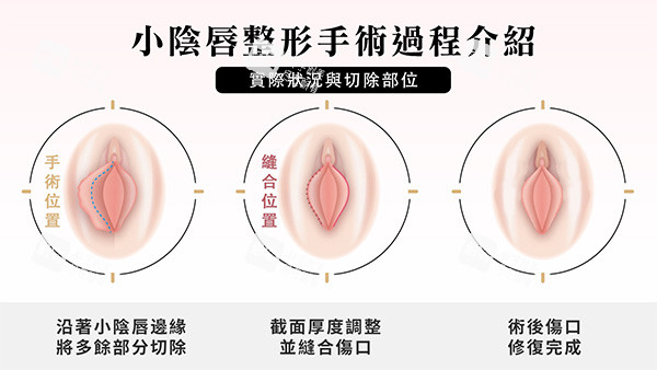 阴唇一边长一边短改善照片.jpg