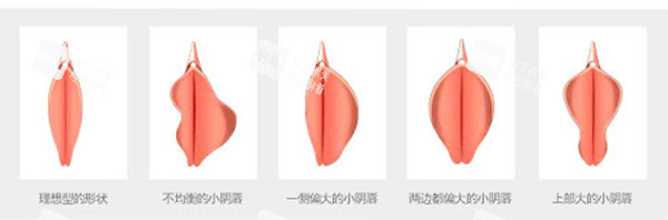 不同阴唇形状情况照片.jpg