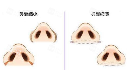 鼻翼缩小.jpg 鼻翼缩小.jpg