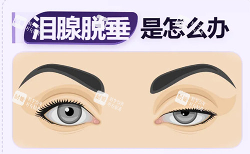 泪腺脱垂怎么办.jpg