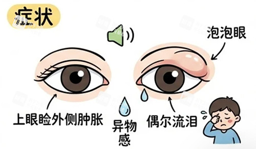 泪腺脱垂的症状.jpg