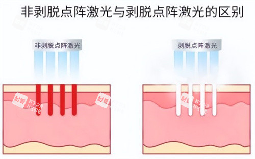 非剥脱点阵激光和剥脱点阵激光.jpg 非剥脱点阵激光和剥脱点阵激光.jpg