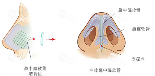 隆鼻鼻中隔软骨鼻.jpg 隆鼻鼻中隔软骨鼻.jpg