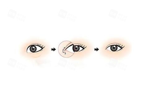开眼角手术前后对比图.png 开眼角手术前后对比图.png