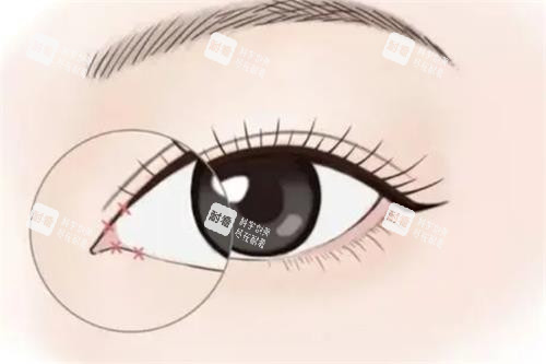开眼角手术动画图示.png 开眼角手术动画图示.png