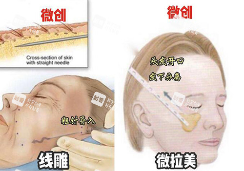 微拉美改善卡通展示.jpg 微拉美改善卡通展示.jpg