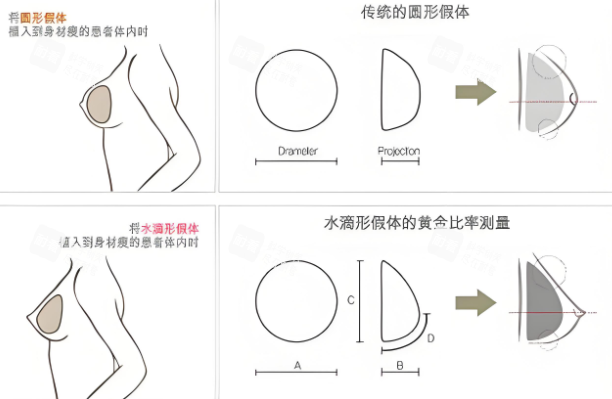 隆胸假体形状对比.png 隆胸假体形状对比.png