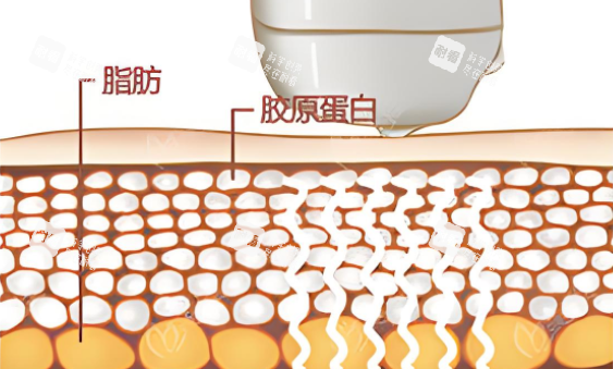激光溶脂图.png 激光溶脂图.png