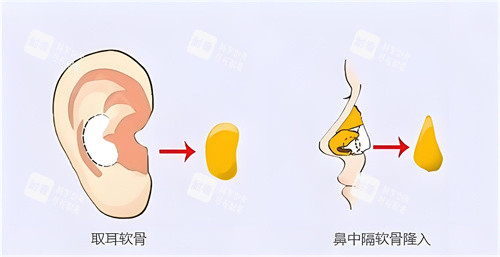 隆鼻耳软骨.jpg