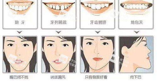 牙齿矫正脸型变化适应症.jpg 牙齿矫正脸型变化适应症.jpg